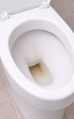 Dépôts de calcaire au fond d'une cuvette de WC